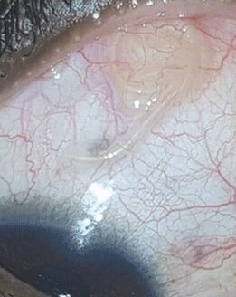 NEOflorax helped get rid of a worm in the eye