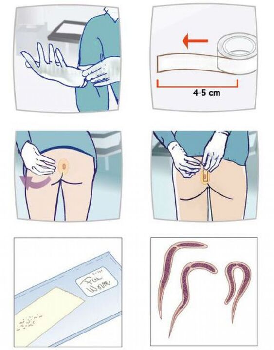 Stool sample for parasite testing