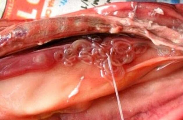 Chance in the gallbladder