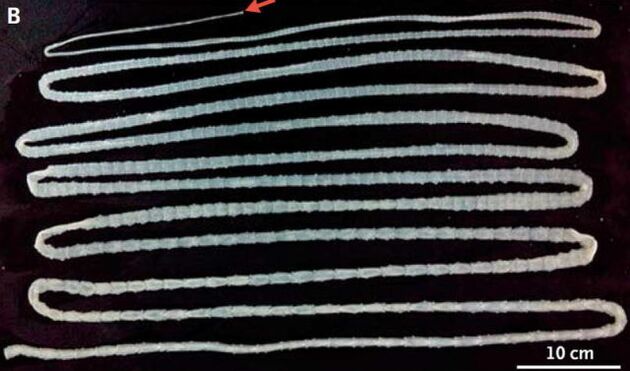 Tapeworm from the human body